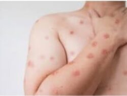 Waspadai Penyakit Mpox, Ini Imbauan Dinkes Pesawaran